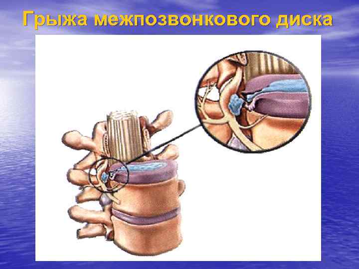 Грыжа межпозвонкового диска 