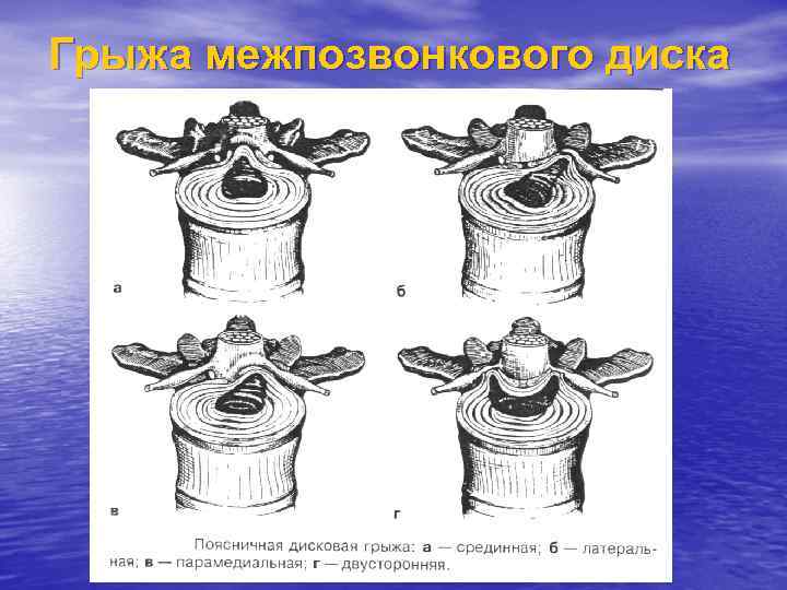 Грыжа межпозвонкового диска 