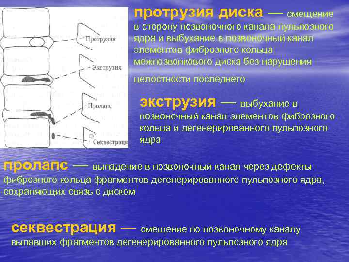 протрузия диска — смещение в сторону позвоночного канала пульпозного ядра и выбухание в позвоночный