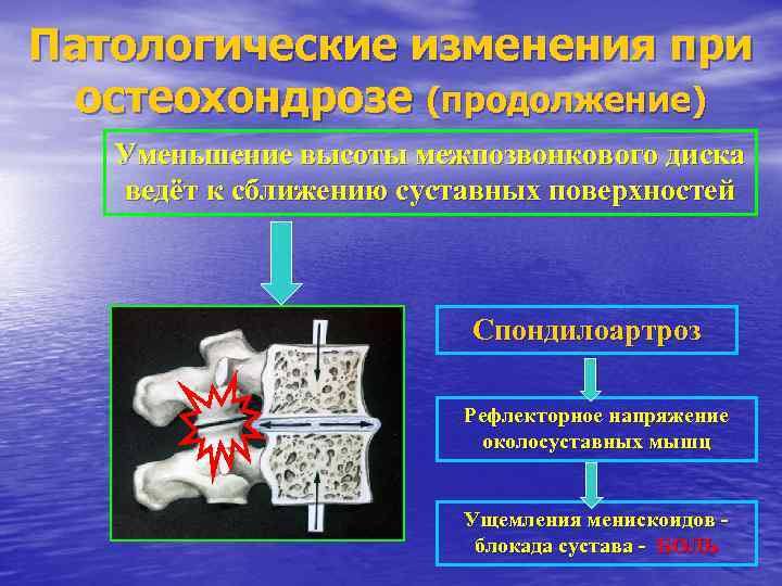 Патологические изменения при остеохондрозе (продолжение) Уменьшение высоты межпозвонкового диска ведёт к сближению суставных поверхностей