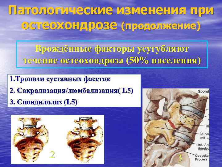 Патологические изменения при остеохондрозе (продолжение) Врождённые факторы усугубляют течение остеохондроза (50% населения) 1. Тропизм