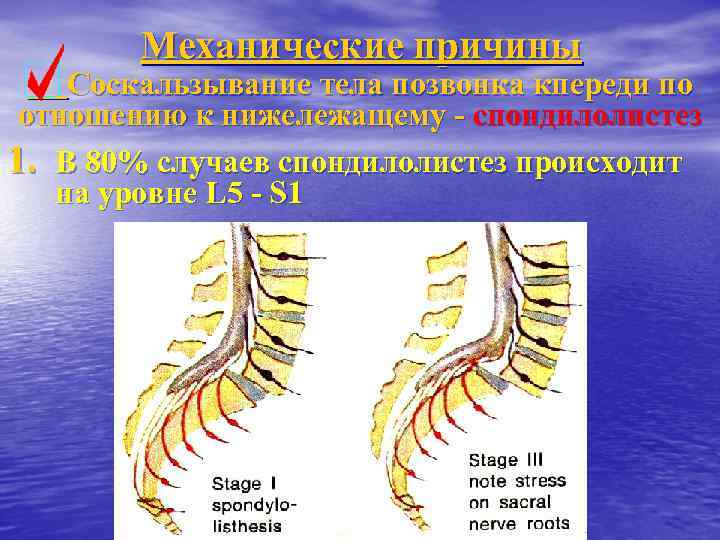 Механические причины Соскальзывание тела позвонка кпереди по отношению к нижележащему - спондилолистез 1. В