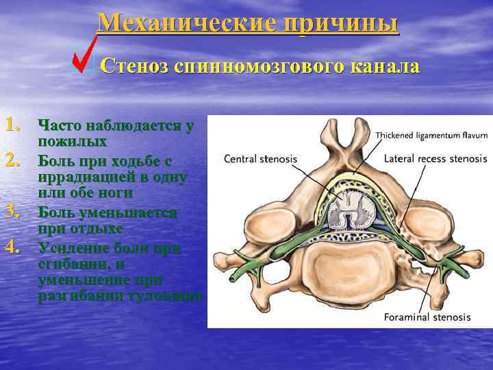 Механические причины Стеноз спинномозгового канала 1. Часто наблюдается у 2. 3. 4. пожилых Боль