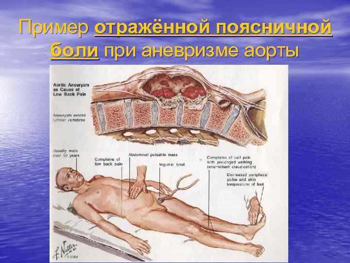 Пример отражённой поясничной боли при аневризме аорты 