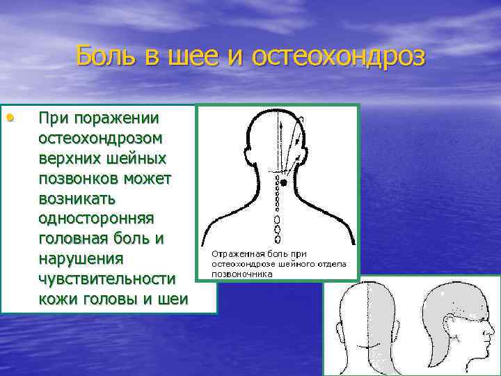 Боль в шее и остеохондроз • При поражении остеохондрозом верхних шейных позвонков может возникать