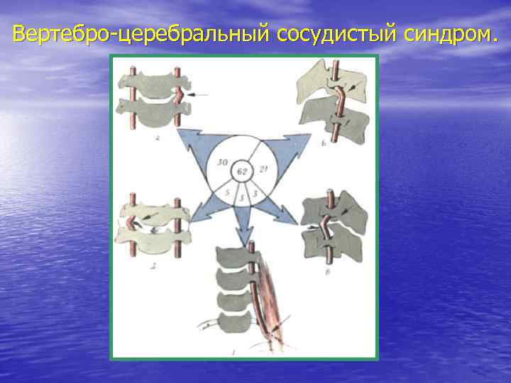 Вертебро-церебральный сосудистый синдром. 