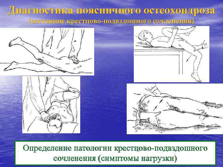 Диагностика поясничного остеохондроза (состояние крестцово-подвздошного сочленения) Определение патологии крестцово-подвздошного сочленения (симптомы нагрузки) 