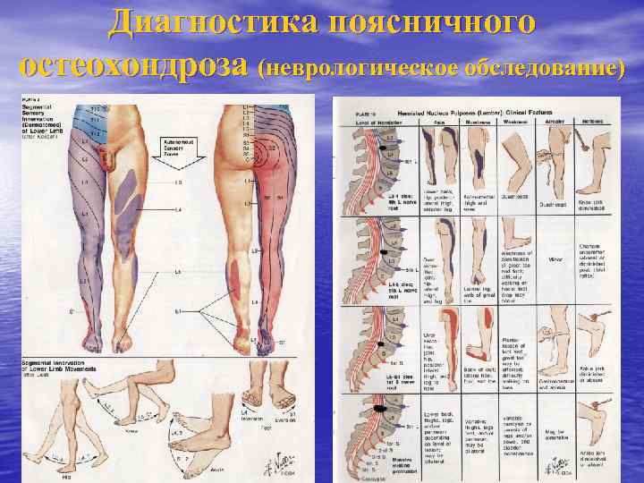 Диагностика поясничного остеохондроза (неврологическое обследование) 