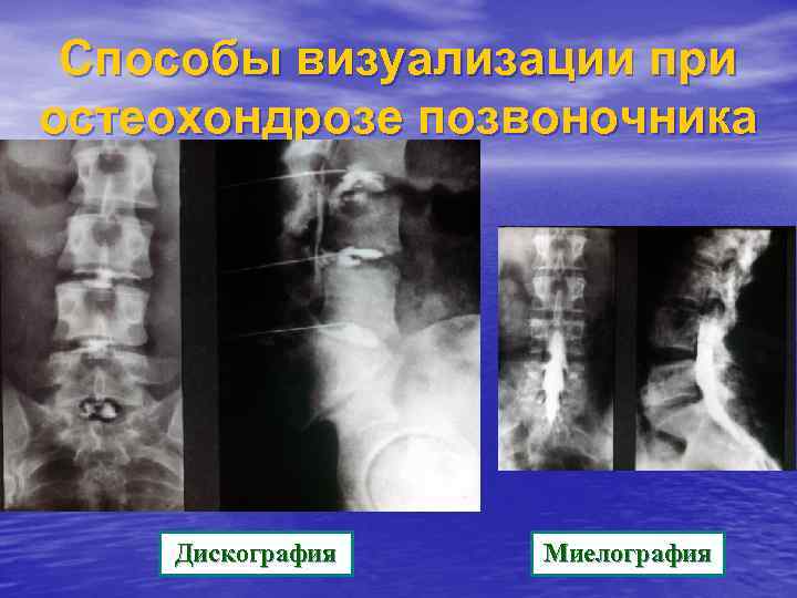 Способы визуализации при остеохондрозе позвоночника Дискография Миелография 