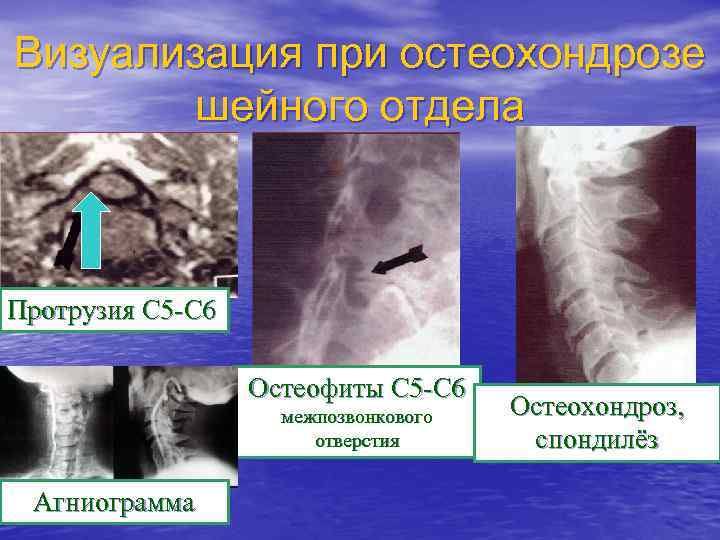 Визуализация при остеохондрозе шейного отдела Протрузия С 5 -С 6 Остеофиты С 5 -С