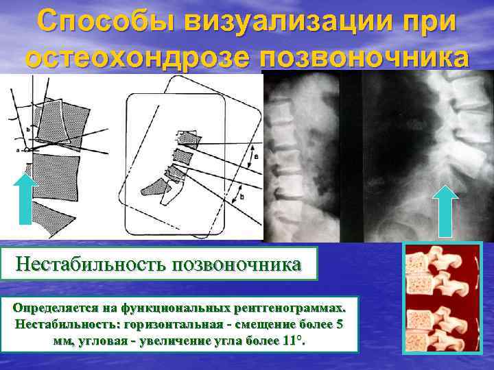 Нестабильность позвоночника. Нестабильность поясничного отдела позвоночника рентген. Нестабильность позвоночника рентген. Нестабильность позвонков рентген. Нестабильность позвонков шоп.