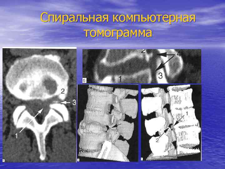 Спиральная компьютерная томограмма 