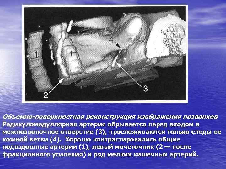 Объемно-поверхностная реконструкция изображения позвонков Радикуломедуллярная артерия обрывается перед входом в межпозвоночное отверстие (3), прослеживаются