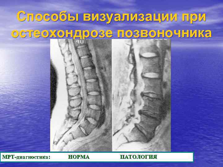 Способы визуализации при остеохондрозе позвоночника МРТ-диагностика: НОРМА ПАТОЛОГИЯ 