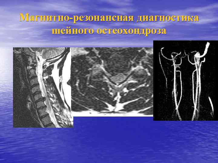 Магнитно-резонансная диагностика шейного остеохондроза 