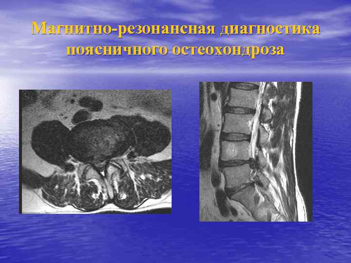 Магнитно-резонансная диагностика поясничного остеохондроза 