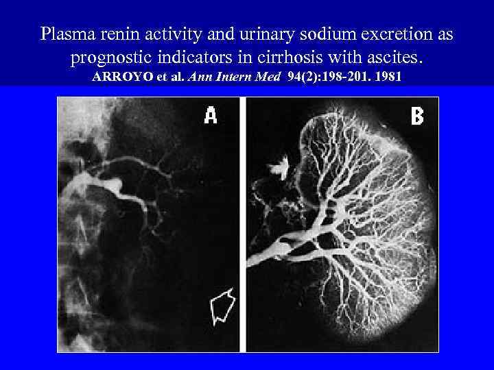 Plasma renin activity and urinary sodium excretion as prognostic indicators in cirrhosis with ascites.