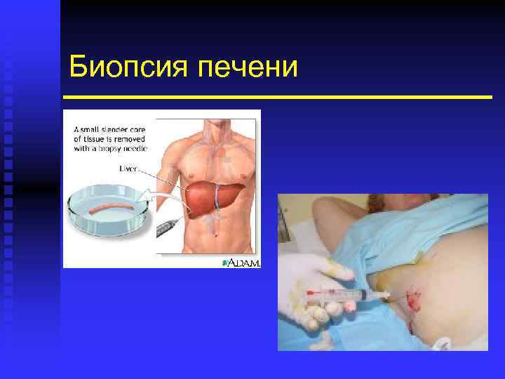 Биопсия печени 