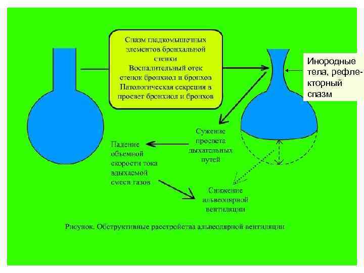 Инородные тела, рефлекторный спазм 