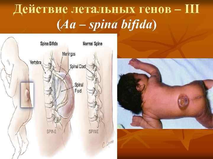 Действие летальных генов – III (Аа – spina bifida) 