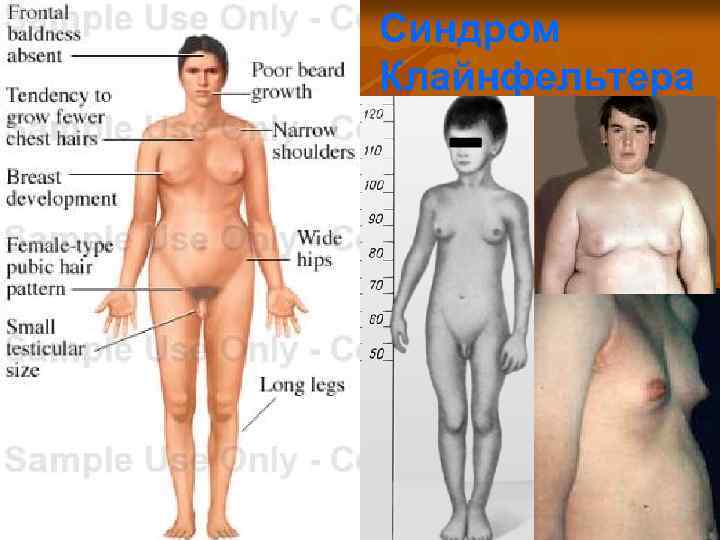 Синдром Клайнфельтера 