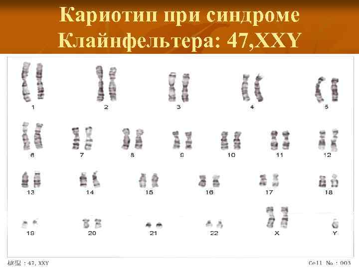 Кариотип при синдроме Клайнфельтера: 47, ХХY 