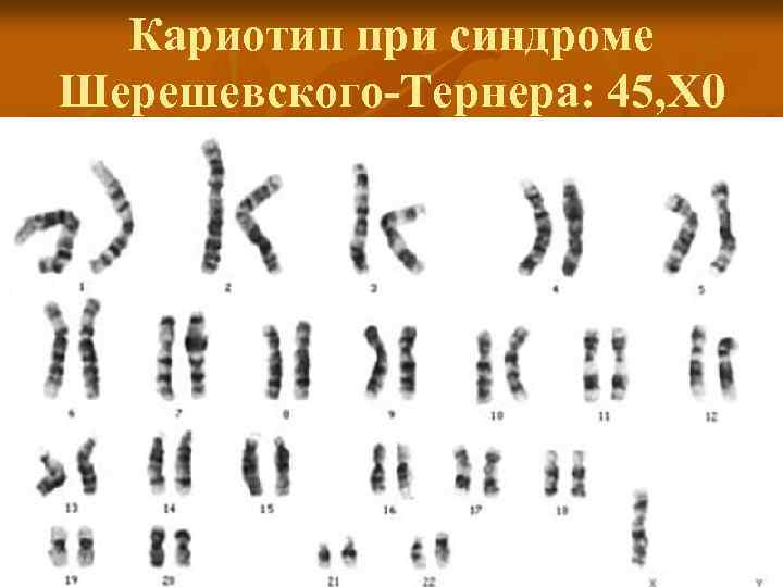 Кариотип при синдроме Шерешевского-Тернера: 45, Х 0 