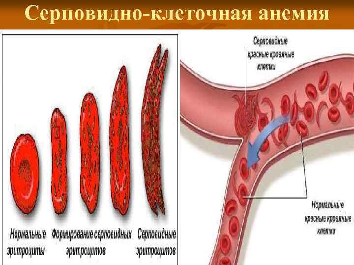 Серповидно-клеточная анемия 