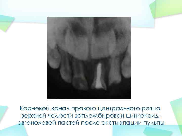 Корневой канал правого центрального резца верхней челюсти запломбирован цинкоксидэвгеноловой пастой после экстирпации пульпы 