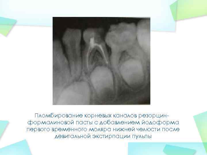 Пломбирование корневых каналов резорцинформалиновой пасты с добавлением йодоформа первого временного моляра нижней челюсти после