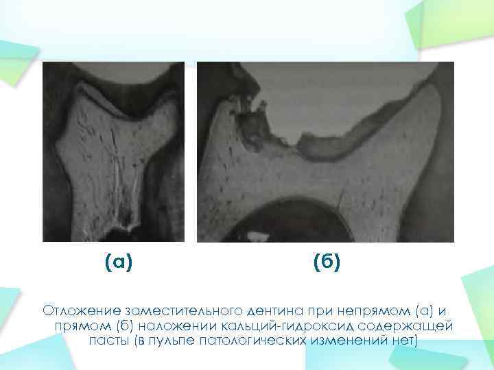 (а) (б) Отложение заместительного дентина при непрямом (а) и прямом (б) наложении кальций-гидроксид содержащей