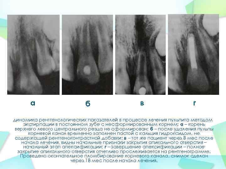 а б в г динамика рентгенологических показателей в процессе лечения пульпита методом экстирпации в