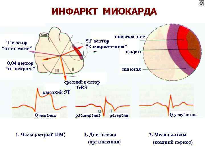 Ишемическая стадия инфаркта миокарда