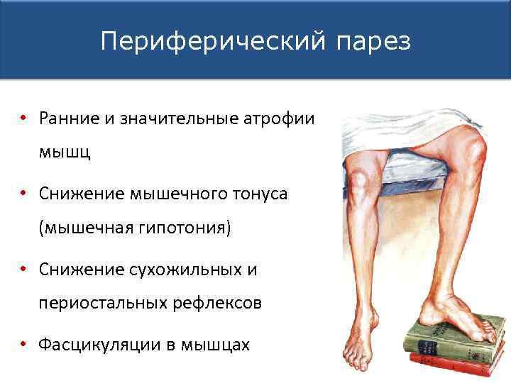 Периферический парез • Ранние и значительные атрофии мышц • Снижение мышечного тонуса (мышечная гипотония)