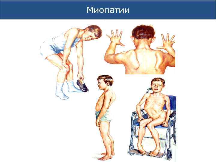 Миопатии 