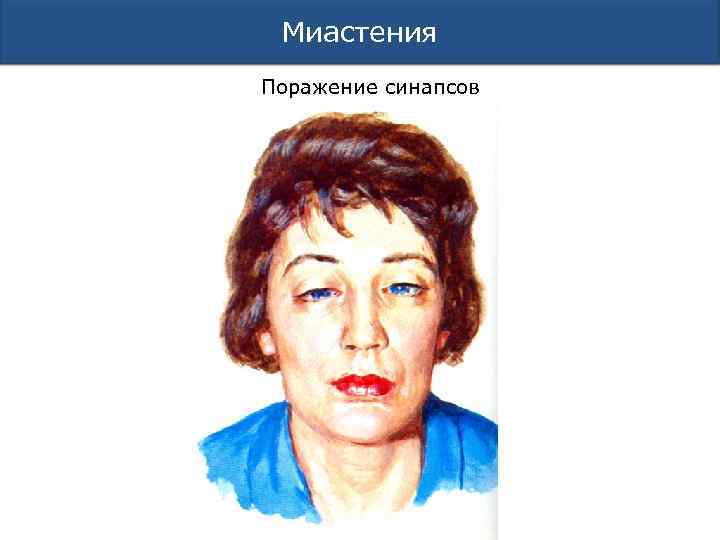 Миастения Поражение синапсов 