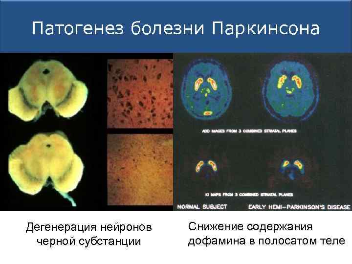 Патогенез болезни Паркинсона Дегенерация нейронов черной субстанции Снижение содержания дофамина в полосатом теле 