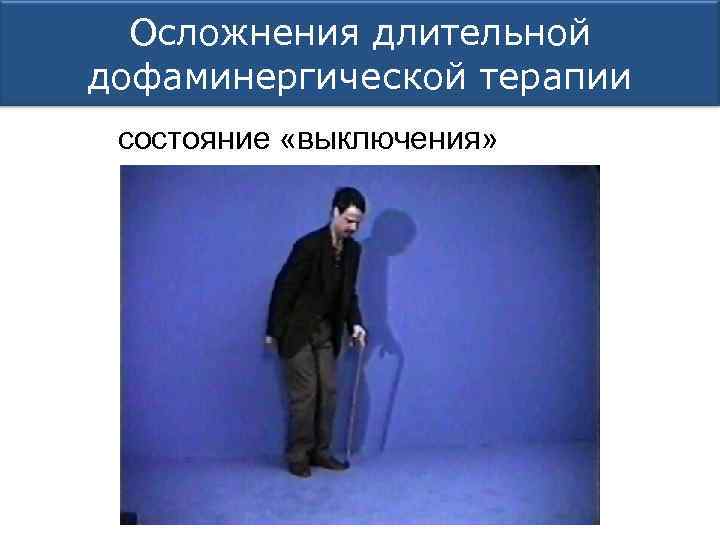 Осложнения длительной дофаминергической терапии состояние «выключения» 