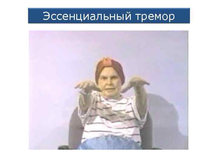 Эссенциальный тремор 