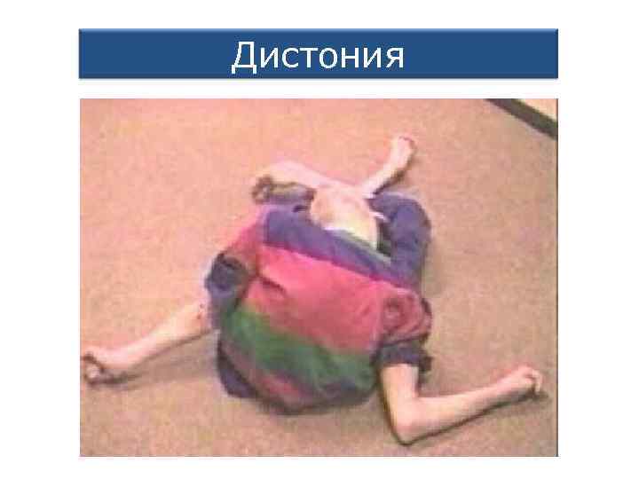 Дистония 