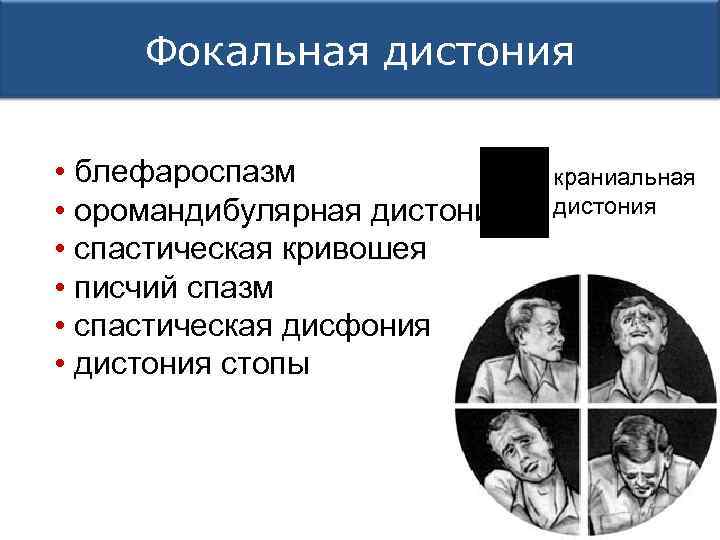 Фокальная дистония • блефароспазм • оромандибулярная дистония • спастическая кривошея • писчий спазм •