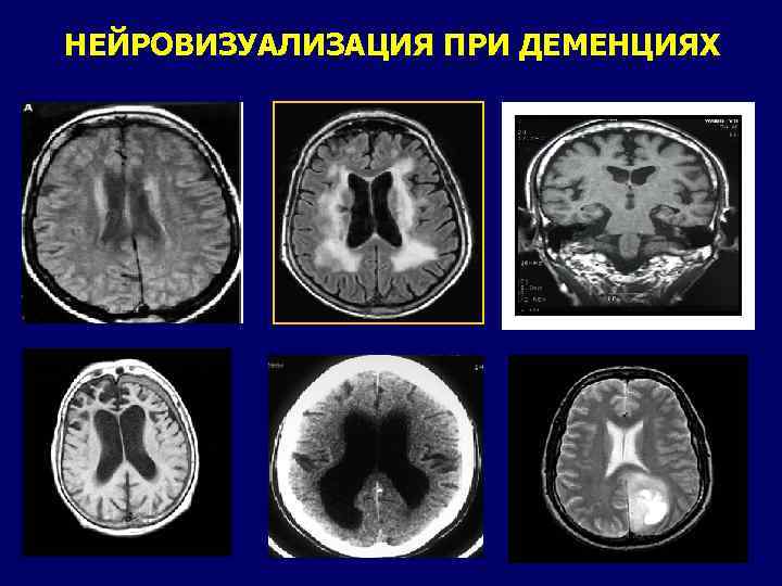 НЕЙРОВИЗУАЛИЗАЦИЯ ПРИ ДЕМЕНЦИЯХ 15 