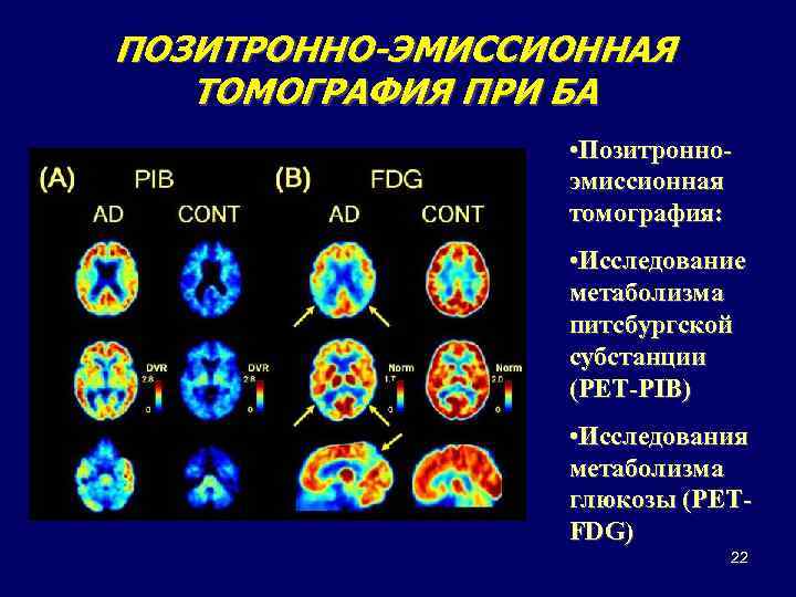 ПОЗИТРОННО-ЭМИССИОННАЯ ТОМОГРАФИЯ ПРИ БА • Позитронноэмиссионная томография: • Исследование метаболизма питсбургской субстанции (PET-PIB) •