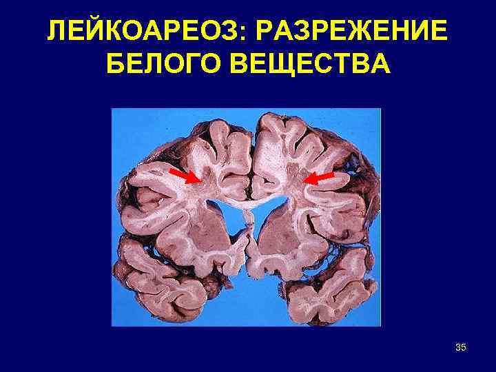 ЛЕЙКОАРЕОЗ: РАЗРЕЖЕНИЕ БЕЛОГО ВЕЩЕСТВА 35 