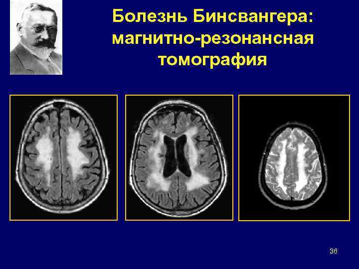 Болезнь Бинсвангера: магнитно-резонансная томография 36 