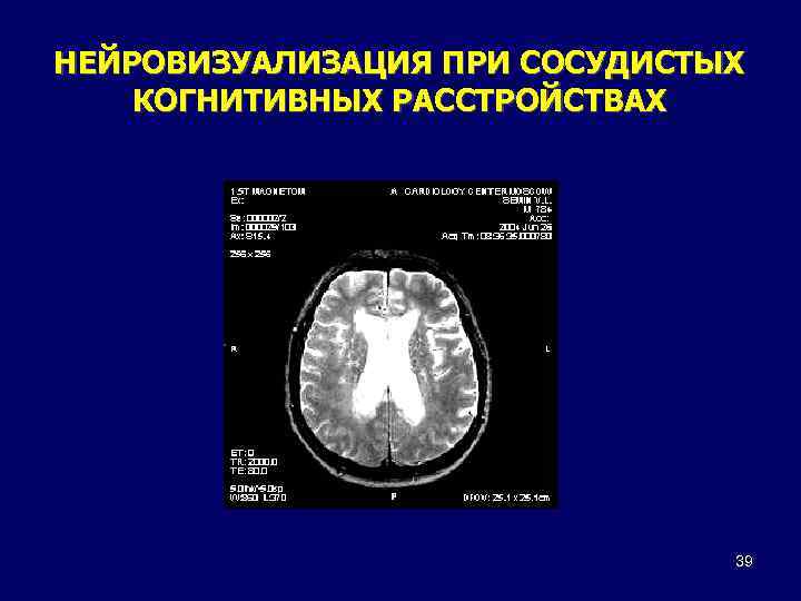 НЕЙРОВИЗУАЛИЗАЦИЯ ПРИ СОСУДИСТЫХ КОГНИТИВНЫХ РАССТРОЙСТВАХ 39 