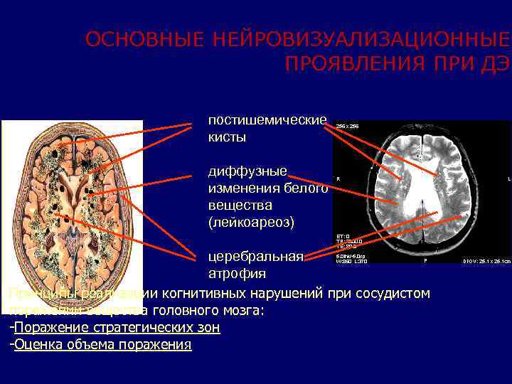 Постишемические кисты мозга