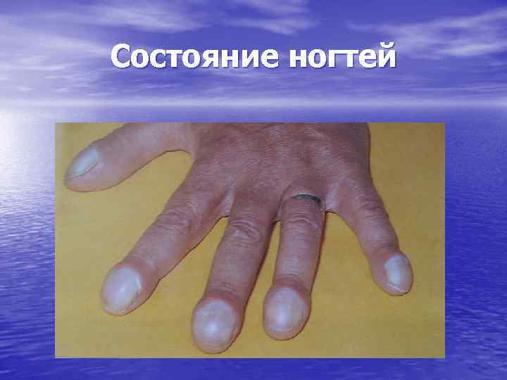 Состояние ногтей 