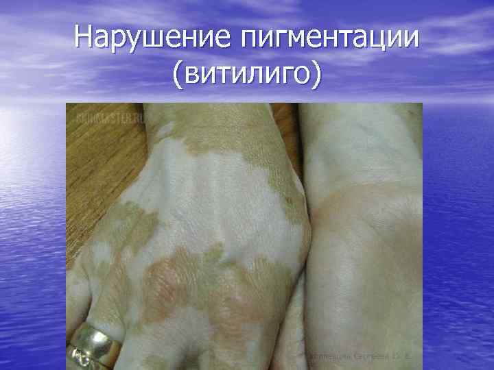 Нарушение пигментации (витилиго) 