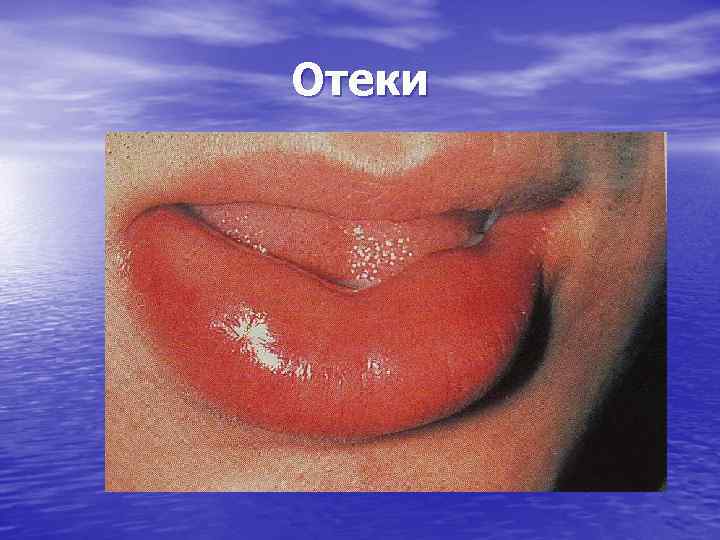 Отеки 